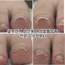 내성발톱발톱무좀관리김수정뷰티 이미지