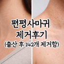 142 | 편평사마귀 제거 후기 142개 제거 한 이유 (한달 반 경과)