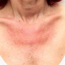 알레르기 이미지