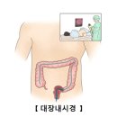 대장암의 정의와 상식 이미지