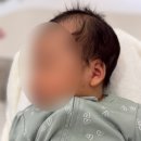 차반점 | 6개월 아기 밀크반점 레이저 7회차 후기, 얼마나 옅어졌을까? (전후 비교)