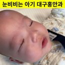 홍안과의원 | 눈 비비는 5개월 아기 눈꼽 대구안과 치료 후기