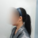 플라덴성형외과의원 | [지방분해주사 플라덴 뽑기주사] 시술 직후, 일주일 후 변화