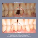 베리굿치과의원 | 송파구거여동치과의원 앞니 부러짐, 임플란트로 회복 가능할까요?