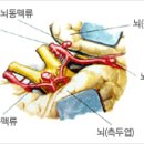 구미원룸임대사업 From 제공 ■ 조용한 살인마, 뇌동맥류 이미지