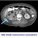 ■ 급성 신우신염의 원인. 증상. 진단. 치료. 합병증 이미지