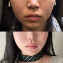 강남 신사역피부과 이중턱, 심부볼 주사 효과 브이디파인 후기 가격