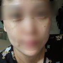 김형진베이직성형외과의원 | 김형진 베이직 성형외과 - 눈밑지방 재배치 + 눈밑지방이식 / 눈밑지 붓기 비용 내돈내산 솔직후기 1탄