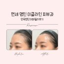 연세명인병원 | 원주 피부과 &lt;연세 명인병원 미클라인&gt; 원주필러, 납작했던 이마 탈출! 원주 이마필러 내돈내산!