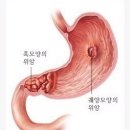 위암(胃癌)의 원인과 예방법(豫防法) 이미지
