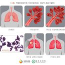 진폐요양급여부지급처분 취소[석공으로 근무하면서 분진작업을 수행] 이미지