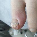 화성프라자 앞 | 화성 봉담 내성발톱 6주 변화 후기 발라발라네일 봉담점