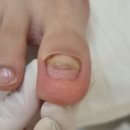 레푸스 잠실역점] 잠실 발톱무좀 관리 후기