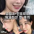 슈붐 | 슈모드 내돈내산 솔직후기｜슈링크 300샷 + 인모드 FX, FORMA 10분 (통증·효과 정리)