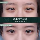 새로성형외과의원 | 쌍꺼풀수술 비용부터 후기사진까지 | 강남 성형외과