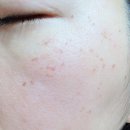 검단 김포 기미 피부관리 비비드엘 기미 잡티케어 미백 피부관리 후기