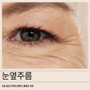 눈옆주름 시술 효과 리쥬란 보톡스 울세라 차이