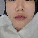 삼성역피부과 셀르디엠 ECM 스킨부스터 효과 통증 2주차 내돈내산 솔직후기