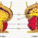 전립선 비대증 이미지