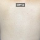 필링 | 은평구 등 여드름 필링 후기