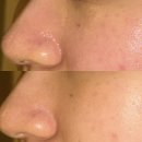 필 | [분당] 서현역피부관리 휘온에스테틱 트로이필 후기