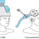 TMS 이미지