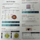 내가 잊어먹지 않으려고 쓰는 이보icl 안내후방 렌즈삽입술 후기부터 궁금증까지~