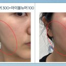 김나영한의원 | 김나영리프팅 볼뉴머 효과 있나요? | 셀프 시술 전후 비교로 솔직 후기