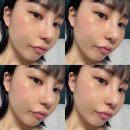 D01021 | [공지] [대구 코수술 후기] 기능코 수술+미용코 수술 / 비염수술후기 (수술당일-10일차) / 비염수술비용