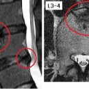 경주 님의 요추디스크 L4-5 , 요추부위 염증 의심 사진입니다. 이미지