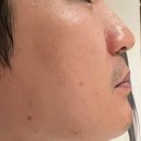 오빠차 | 홍대 남자수염제모 추천 : 리버스의원 홍대점 1회차 후기 (오빠 숙원사업 성공!!)