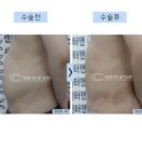 복비뇨기과의원 | 남자지방흡입후기? 2,800여건을 이끈 의사의 고백