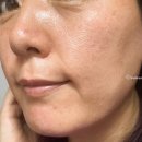 고잔동 507-5~고잔동 622 주변 | 안산 고잔동 피부관리 깨끗한피부나라 피부지우개프로그램 솔직후기 (feat. 비립종, 기미잡티 관리)