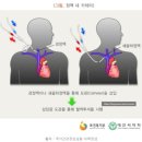 도관삽입술 소아탈장수술비 특별약관 수술의 정의에 해당하는지 여부 이미지