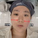 더400 | 구디피부과 올타이트400샷 후기(리프팅 맛집, 비포에프터리얼후기)