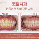 중앙보훈병원역 | 중앙보훈병원역치과, 벌어지고 틀어진 앞니(정중이개) 치아교정 사례