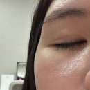 한국도로공사 앞-A(좌측) | 인디언밴드필러/앞볼필러/앞광대필러 눈밑꺼짐 전후 후기/통증/내돈내산/부작용