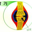 관절염-관절염에대해서 알아보자 이미지