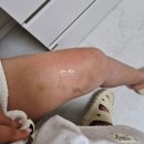 [일원1] 나의 피부를 설계하다 (6주: 3/4~4/8) | 알레르기 내과 두드러기 병원 치료 증상 | 6~8주차 고용량 항히스타민