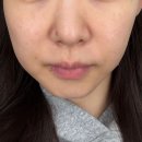 고우리 | 역삼동피부과 콜라겐 스킨부스터 고우리+더마샤인 후기 가격