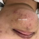 구리남양주 여드름 흉터 색소 잘하는 곳 추천 다산동 셀앤수