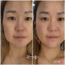 마린슈퍼 | 마린시티 윤곽 리프팅 전문점 미엘르 에스테틱 슈퍼맥스 초음파 리프팅 후기