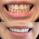 스마일라인치과기공소 | 오산 라미네이트 무삭제로 누런니 탈출하고 예뻐진 후기!