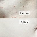 거나 | 편평사마귀 치료 후기 (내돈내산) 여자 원장님이라 더 편했던 상체 편사제거 경험