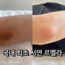 부산 서면 르멜라 색소침착 착색 1회 변화 내돈내산 후기