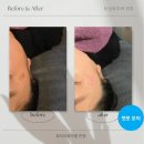 춘천 기미잡티 피부관리 ‘뷰티오로라엘본점’