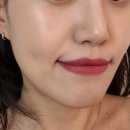 청담동피부과 튠페이스 고주파리프팅 후기