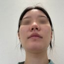 강남씨티약국 | 강남역성형외과에서 첫코성형 일주일차 코수술 후 통증+붓기관리 완벽정리