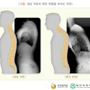 의학 관련 사람들아 척추 후만증 아닌데 그냥 등 굽히고 있으면 이미지