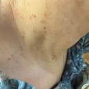 성북본튼튼의원 | [편평사마귀 제거 후기] 자연튼튼의원 예약 성공, 가격, 엄마 대만족 후기